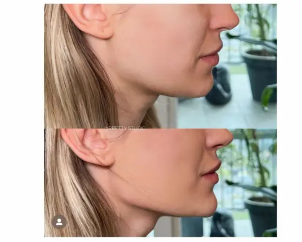 Endermologia twarzy: Lifting bez skalpela? Sprawdź efekty!