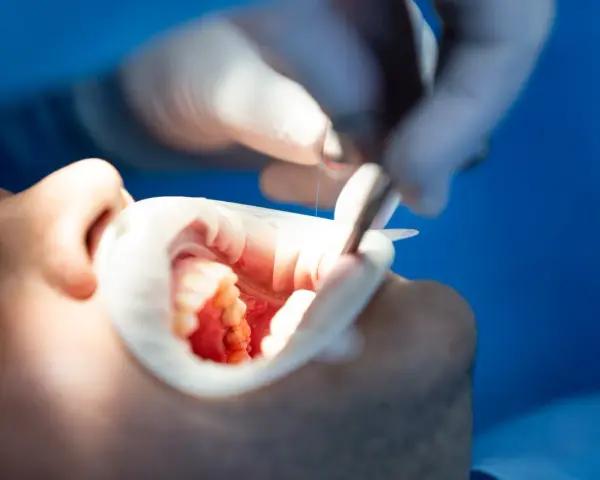 Dentysta wykonuje leczenie kanałowe zęba, używając narzędzi do precyzyjnej pracy w jamie ustnej pacjenta.