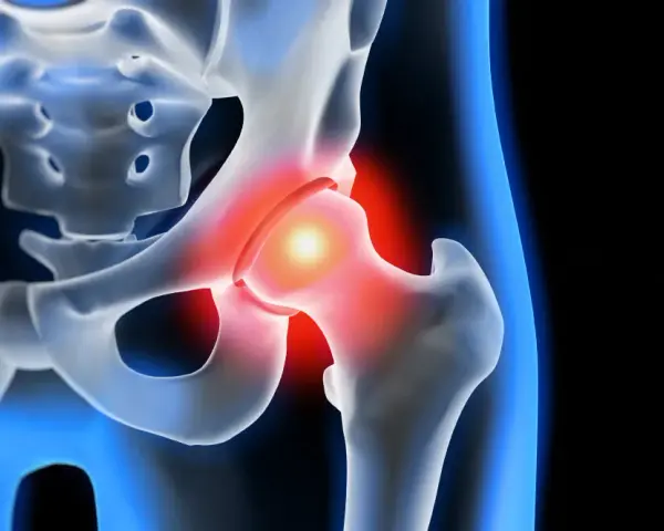 Coxarthrose Symptome: So erkennen Sie die schmerzhaften Anzeichen