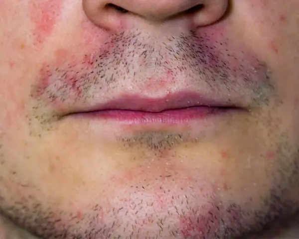 Schuppige Gesichtshaut Make-up: So vermeiden Sie trockene Flecken