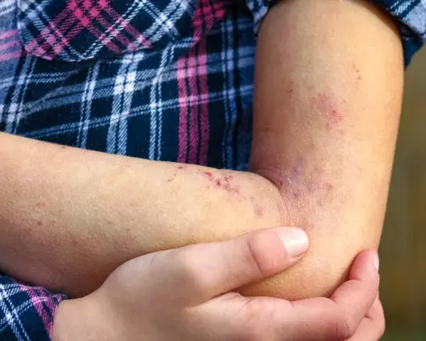 Wysypka jak ugryzienie komara u dziecka? Pokrzywka, alergia, Skeeter