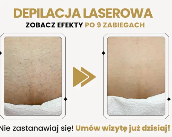 Depilacja laserowa bikini przed i po: widoczna redukcja owłosienia po 9 zabiegach. Gładka skóra bez podrażnień.