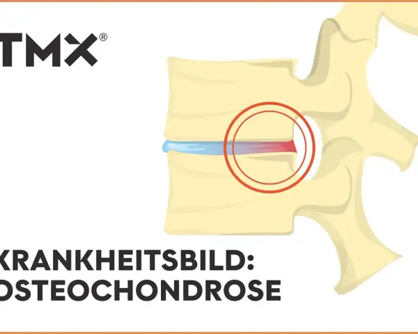 Darstellung eines Wirbels mit Bandscheibenschaden. Bei Osteochondrose wie geht es weiter? TMX Logo.