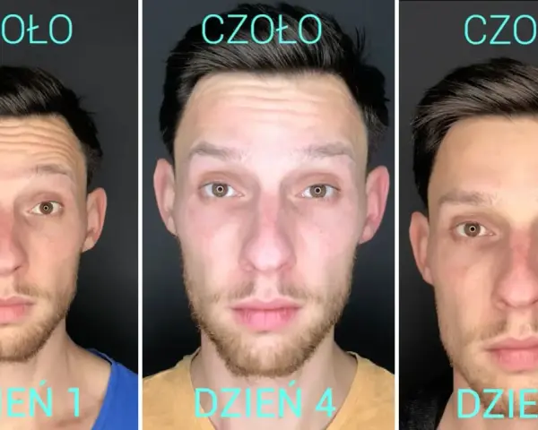 Przed i po baby botox na czole. Widoczne wygładzenie zmarszczek w ciągu 7 dni.