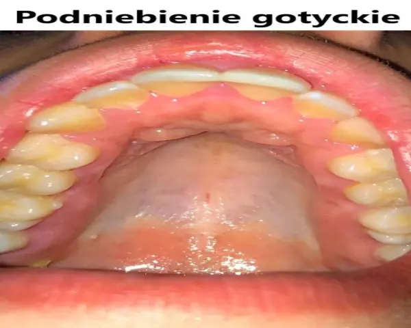 Widok jamy ustnej z zębami i podniebieniem. Charakterystyczne, ząbkowane linie dziąseł tworzą podniebienie gotyckie.