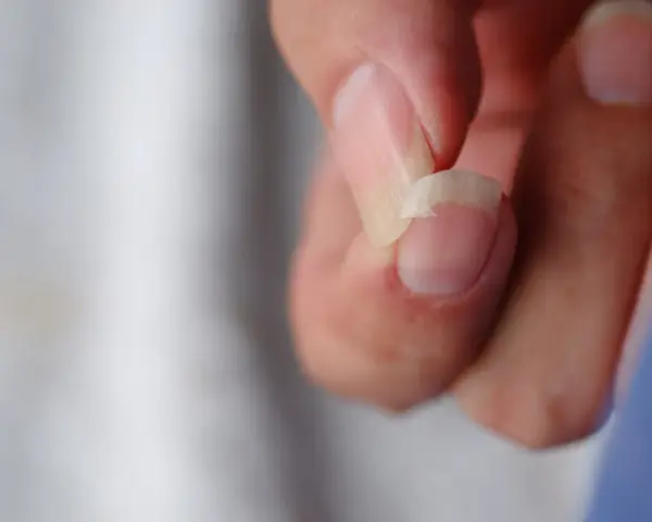 Un ongle se casse, une question se pose : pourquoi mes ongles se cassent ? Gros plan sur un ongle abîmé.