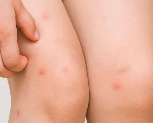 Piel de niño con pequeños bultos rojos, indicativos de foliculitis en las piernas.