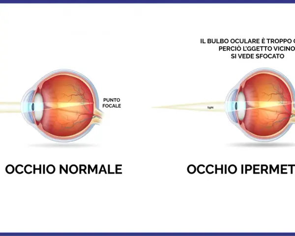 Confronto tra occhio normale e occhio ipermetrope: in quest'ultimo, il bulbo corto fa sì che l'oggetto vicino si veda sfocato.