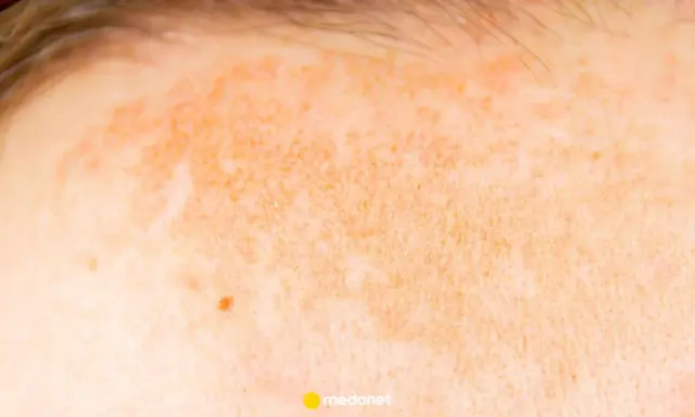 Skóra z zaczerwienieniem i przebarwieniami, objawy fotodermatozy – uczulenia na słońce. Widoczne włoski i pieprzyk.