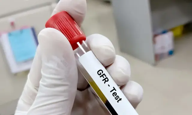 Rękawiczka trzyma probówkę z oznaczeniem "GFR - Test". To jedno z badań na nerki, które ocenia ich pracę.