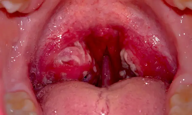 Gola infiammata con placche biancastre, indicative di faringite da streptococco. Le tonsille sono rosse e gonfie.