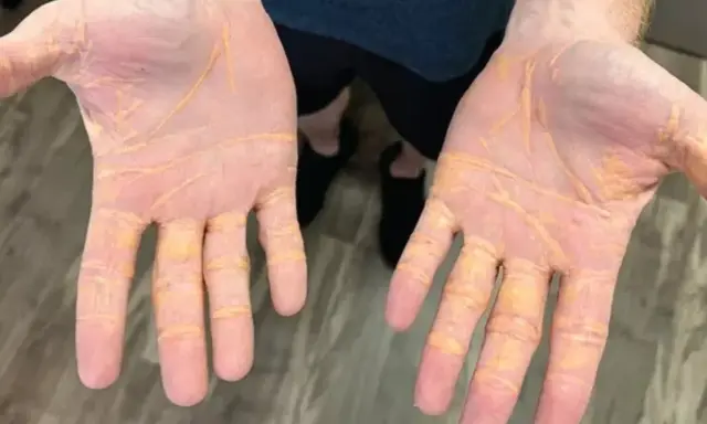 Dłonie z żółtymi zmianami skórnymi, mogącymi świadczyć o wysokim cholesterolu.