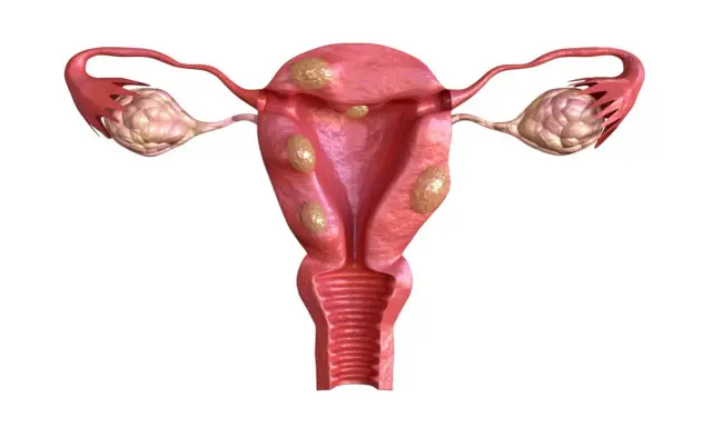 Anatomical illustration of a uterus with multiple fibroids and ovaries.