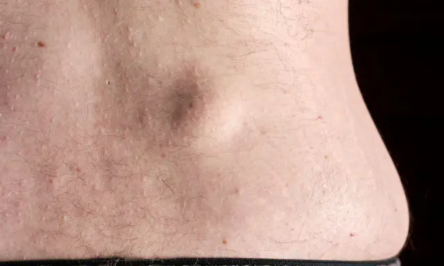 Gros plan sur le dos d'une personne, montrant une peau claire parsemée de petites bosses et d'une excroissance peau plus visible.