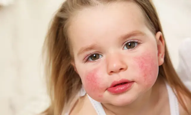 Alergia pokarmowa u dzieci: objawy skórne? Co robić krok po kroku