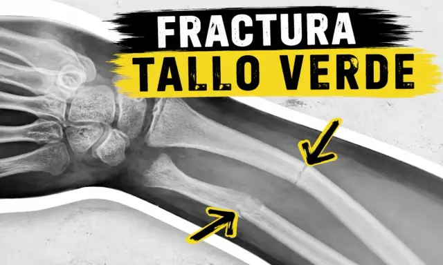 Radiografía de una fractura en tallo verde en el antebrazo, indicada por flechas amarillas.