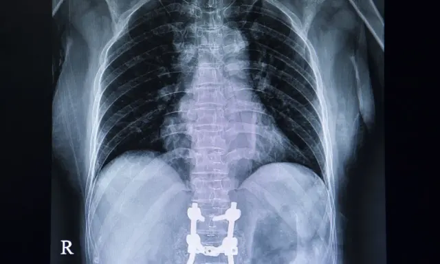 Rentgen klatki piersiowej po operacji kręgosłupa. Widoczny stabilizujący kręgosłup implant.