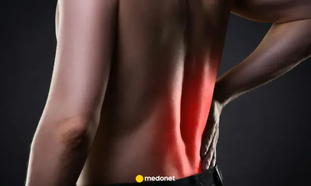 Ból pleców, który może być spowodowany przez ucisk na korzonki, objawia się jako rwa kulszowa. Czerwony obszar na plecach sugeruje stan zapalny.
