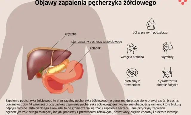 Ilustracja przedstawia anatomię jamy brzusznej z zaznaczonym pęcherzykiem żółciowym, wątrobą i żołądkiem. Wymienia objawy zapalenia pęcherzyka żółciowego: ból, wzdęcia, wymioty, problemy z trawieniem.