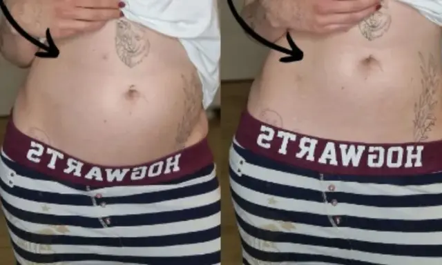 Porównanie brzucha: po lewej widoczne wzdęcia, po prawej płaski. Endometrioza jak wygląda? Czasem tak.