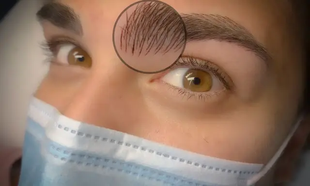 Gros plan sur un œil et un sourcil, avec un zoom sur une fine cicatrice au sourcil, cachée par quelques poils.