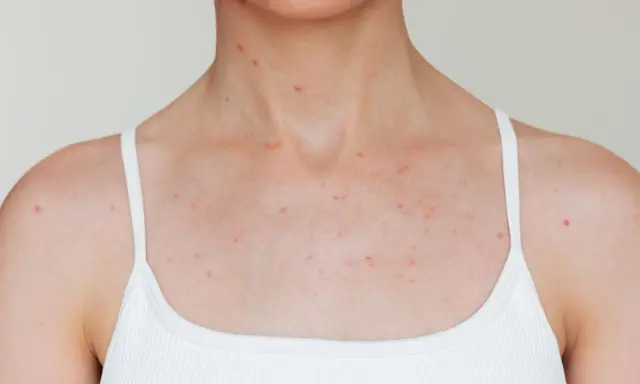 Poitrine et cou couverts de petits boutons rouges.