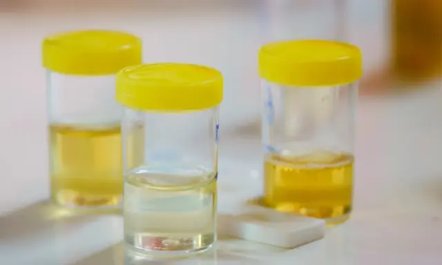Pojemniki z żółtymi nakrętkami zawierają próbki moczu do analizy. Na stole leży też test diagnostyczny, który może wykryć np. urobilinogen w moczu.