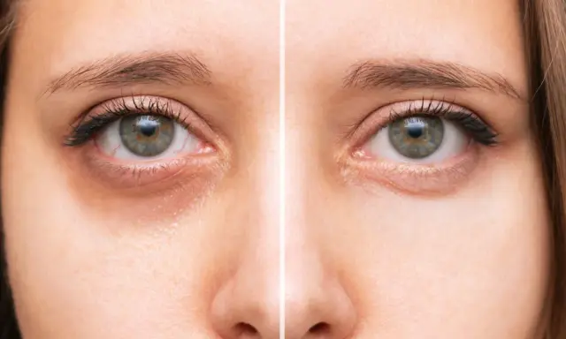 Comparaison avant/après : des yeux fatigués avec des cernes prononcés à des yeux reposés et lumineux.