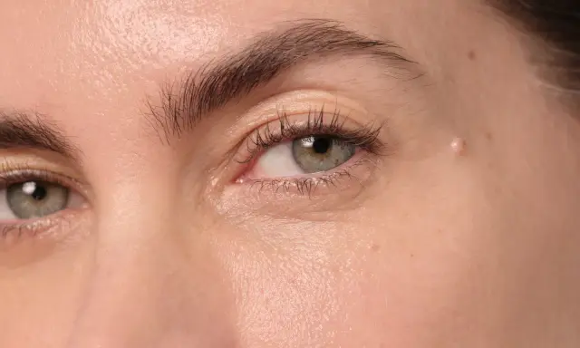 Gros plan sur un œil, montrant une peau claire avec une petite lésion sur la paupière, possiblement un signe de psoriasis paupière.