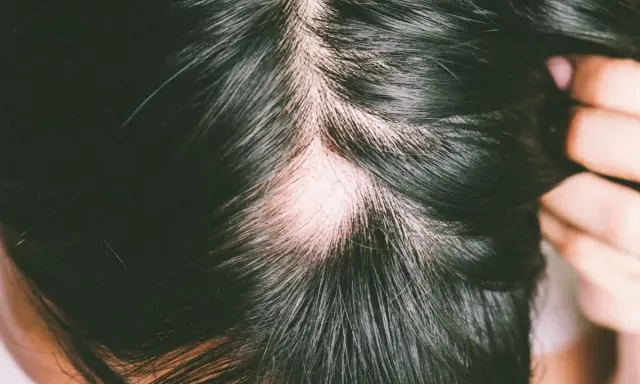 Plaque d'alopécie sur le cuir chevelu, révélant une peau pâle au milieu de cheveux foncés.