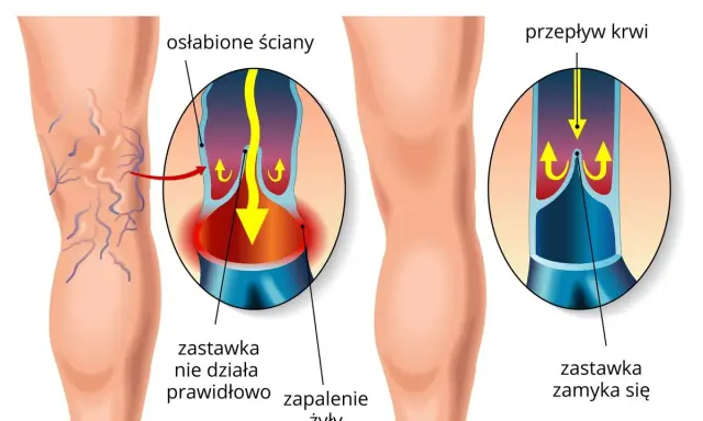 Porównanie żylaków i zdrowych żył. W żylakach zastawka nie działa, powodując zastój krwi. W zdrowych żyłach zastawka zamyka się prawidłowo.