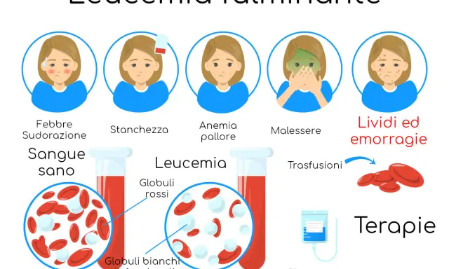 Leucemia fulminante: febbre, stanchezza, anemia, malessere, lividi. Globuli bianchi disfunzionali. Terapie: trasfusioni, chemioterapia.