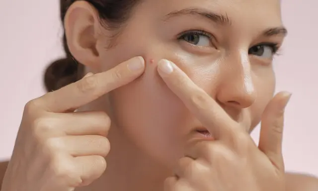 Une femme examine un furoncle sur son visage, ses doigts pointant vers la petite imperfection rouge sur sa joue.