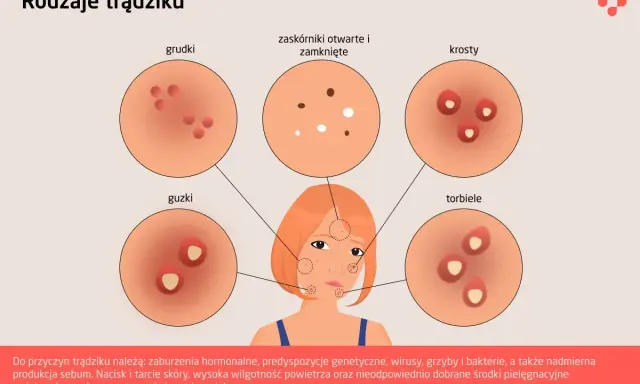 Ilustracja pokazuje, jak wygląda trądzik: grudki, krosty, guzki, torbiele i zaskórniki.