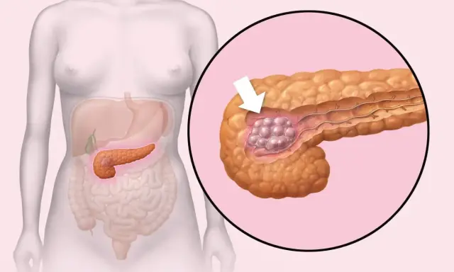 Ilustracja przedstawia trzustkę z guzem, wskazując na potencjalne przyczyny raka trzustki.