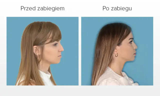Przed i po zabiegu: poprawa wyglądu twarzy dzięki korekcie wady zgryzu.