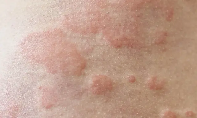 Czerwone, swędzące bąble na skórze. Czy pokrzywka jest zaraźliwa? Nie, to reakcja alergiczna, nie przenosi się przez kontakt.