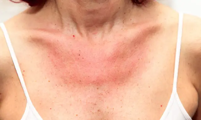 Poitrine rouge et irritée, signe d'une allergie au soleil. Un remède grand-mère pourrait soulager cette peau sensible.