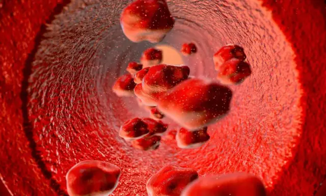 Czerwienica prawdziwa to choroba mieloproliferacyjna, nie nowotwór złośliwy. Widok naczyń krwionośnych z nadmiarem czerwonych krwinek.