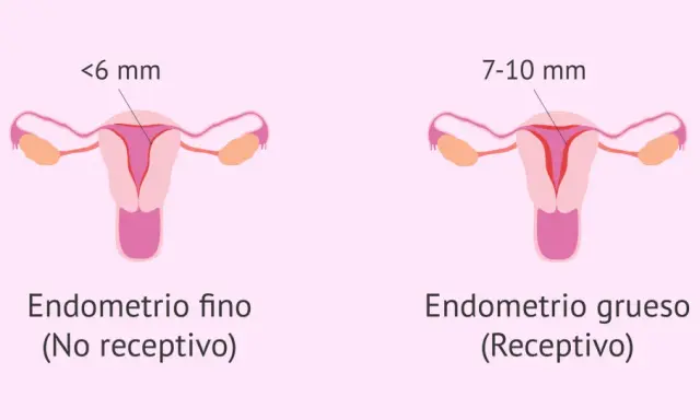 Ilustración comparativa de úteros. Uno muestra un endometrio fino (<6 mm, no receptivo), el otro un endometrio grueso (7-10 mm, receptivo).