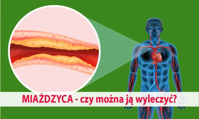 Ilustracja przedstawia ludzkie ciało z widocznym układem krążenia i powiększony przekrój tętnicy z miażdżycą. Jakie badania na miażdżycę są kluczowe?