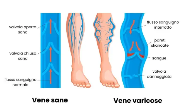 Illustrazione che mostra vene sane e vene varicose, evidenziando i problemi di insufficienza venosa gambe rimedi.