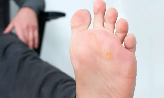 Un pied présente des cors, notamment un cors au pied bien visible sous la plante. La personne semble s'apprêter à soigner cette affection.