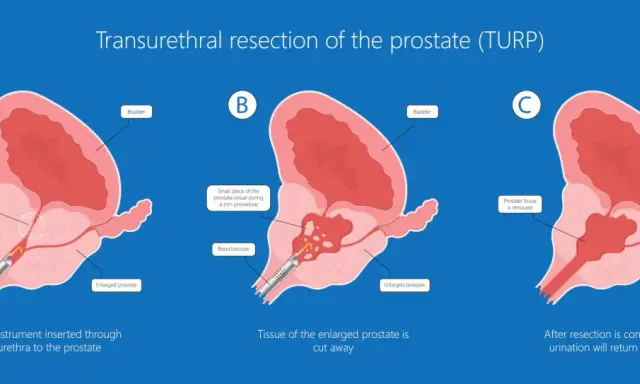 Ilustracja pokazuje etapy elektroresekcji prostaty (TURP), gdzie nadmiar tkanki jest usuwany przez cewkę moczową, przywracając prawidłowy przepływ moczu.
