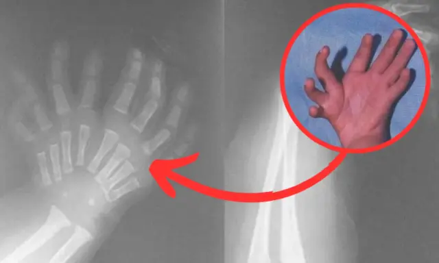 Syndrom obcej ręki: Czy to możliwe, że ręka działa sama? Poznaj prawdę