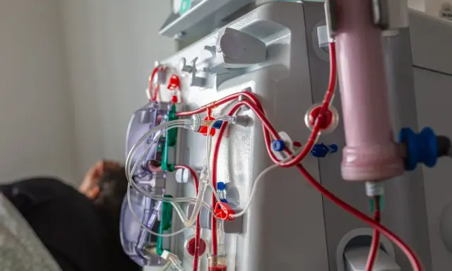 Dializa to często długotrwałe leczenie, ale nie zawsze jest do końca życia. Maszyna do dializy z czerwonymi i przezroczystymi przewodami.