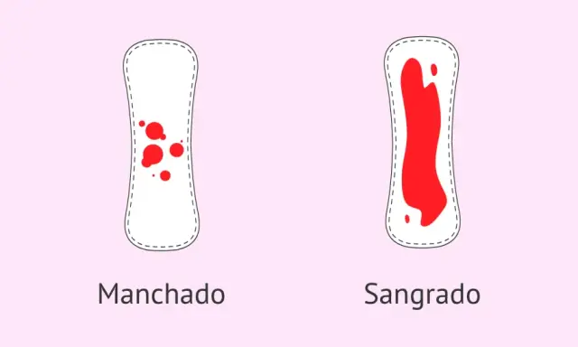 Dos compresas: una con manchado leve y otra con sangrado abundante. Puede ser un signo de embarazo con la regla.