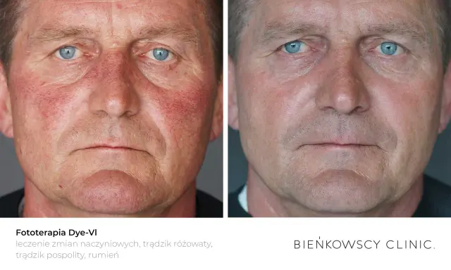 Przed i po fototerapii Dye-VI. Zmniejszenie zaczerwienienia i wyprysków na twarzy po 50-tce.