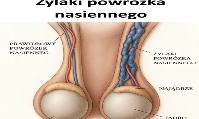 Ilustracja porównuje prawidłowy powrózek nasienny z żylakami powrózka nasiennego. Tak, czy z żylakami powrózka nasiennego można żyć, choć mogą wpływać na płodność.