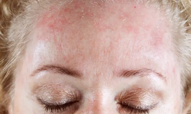Fronte arrossata e desquamata, un segno di dermatite seborroica. Speriamo in un miracolo dermatite seborroica per ritrovare una pelle sana.